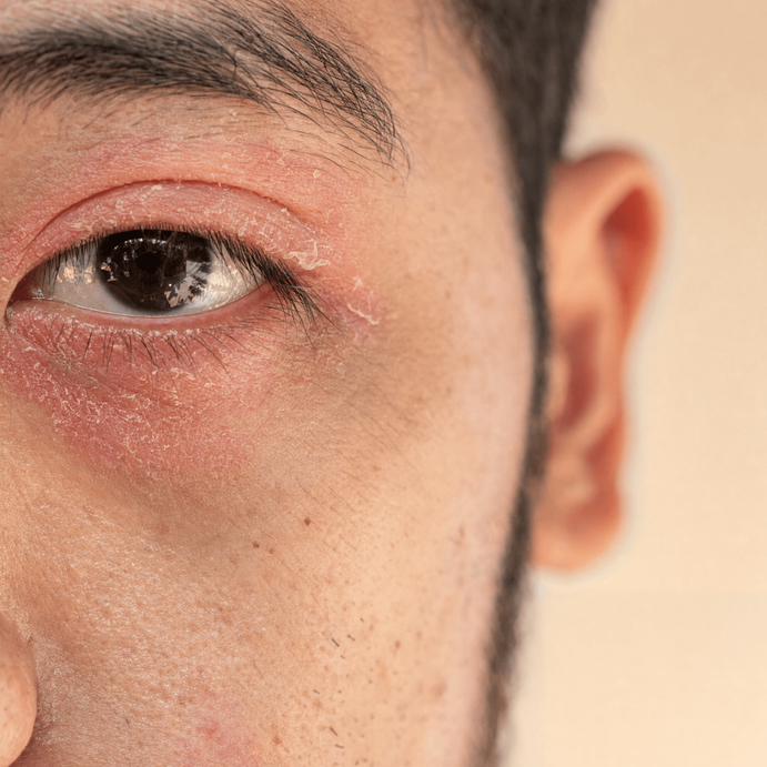 Anzeichen für Neurodermitis am Auge
