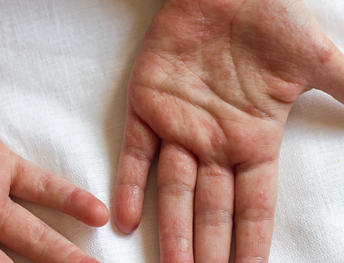 Das dyshidrotische Ekzem: eine Sonderform an Händen und Füßen