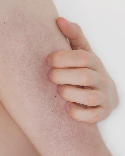 Wie wird die atopische Dermatitis vom Arzt diagnostiziert?