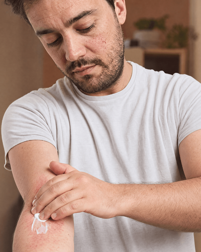 Neurodermitis Behandlung: Stufentherapie & Akutbehandlung