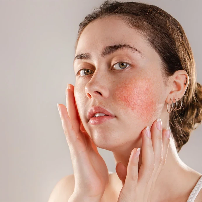 Alles über Rosacea