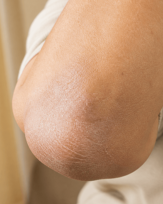 Trockene Ellenbogen & Knie: Ursachen, Behandlung und wirksame Pflegetipps