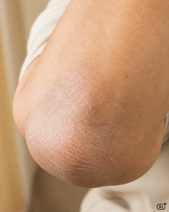 Trockene Ellenbogen & Knie: Ursachen, Behandlung und wirksame Pflegetipps