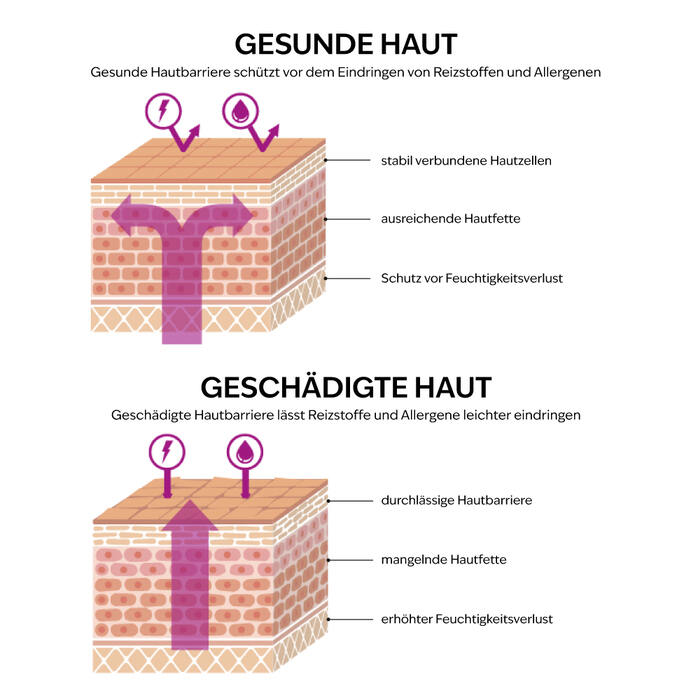 Allergien und eine gestörte Hautbarriere