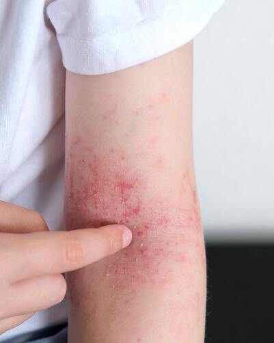 Neurodermitis: Definition & Häufigkeit atopischer Dermatitis