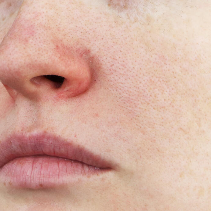 Laserbehandlung bei Rosacea