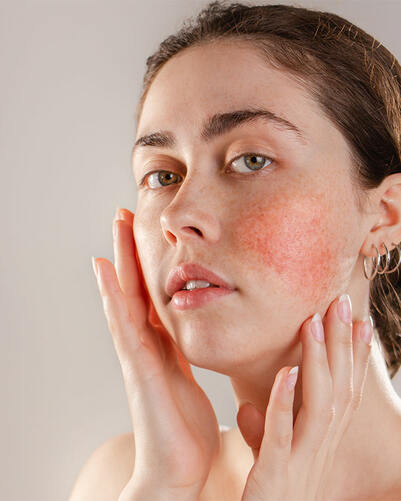 Rosacea: Symptome, Trigger & Behandlung geröteter Haut