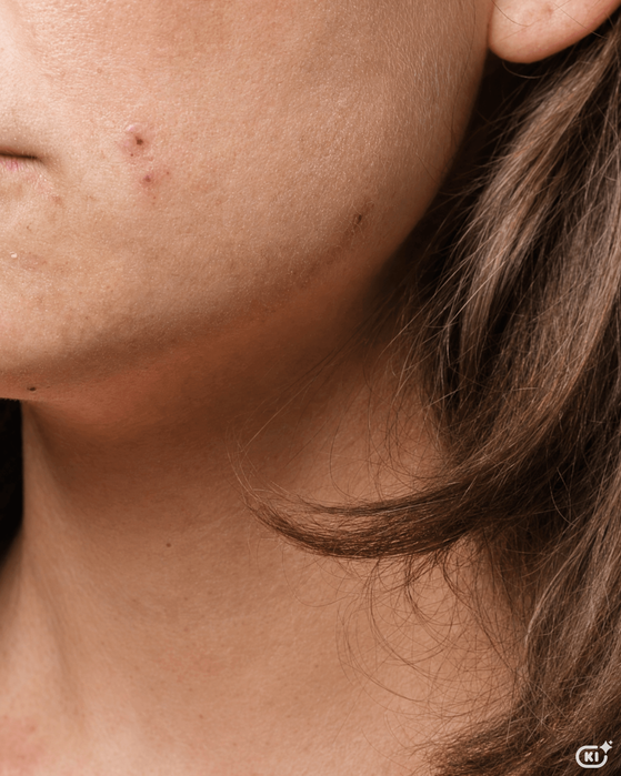 Neurodermitis im Gesicht: Symptome, Make-up & Pflege