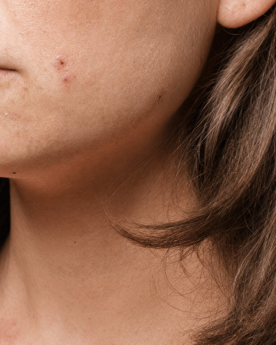 Neurodermitis im Gesicht: Symptome, Make-up & Pflege