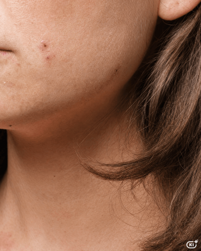 Neurodermitis im Gesicht: Symptome, Make-up & Pflege