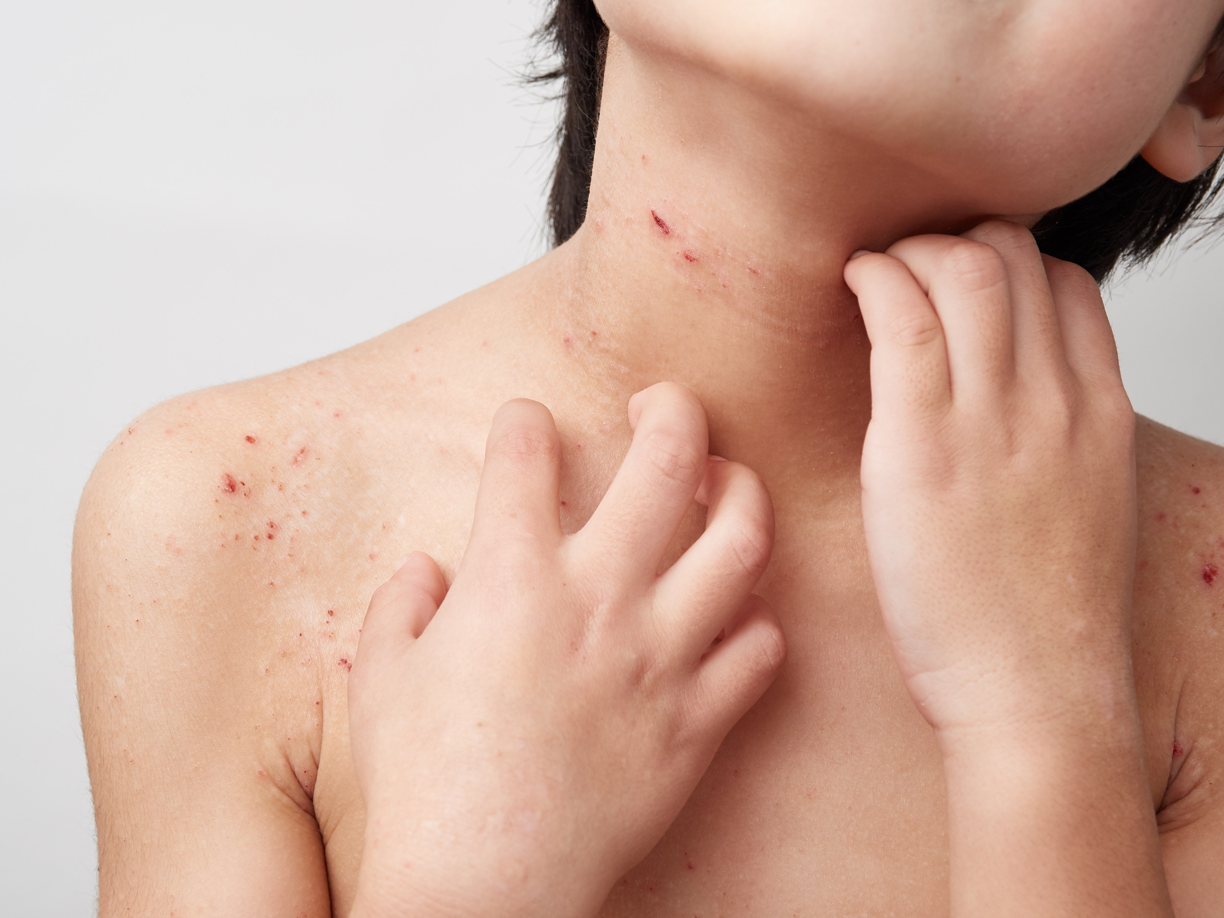 Frau kratzt sich während eines akuten Neurodermitis-Schubs am Hals. Sichtbare Symptome sind Kratzspuren und Ekzeme an Hals und Schulter.