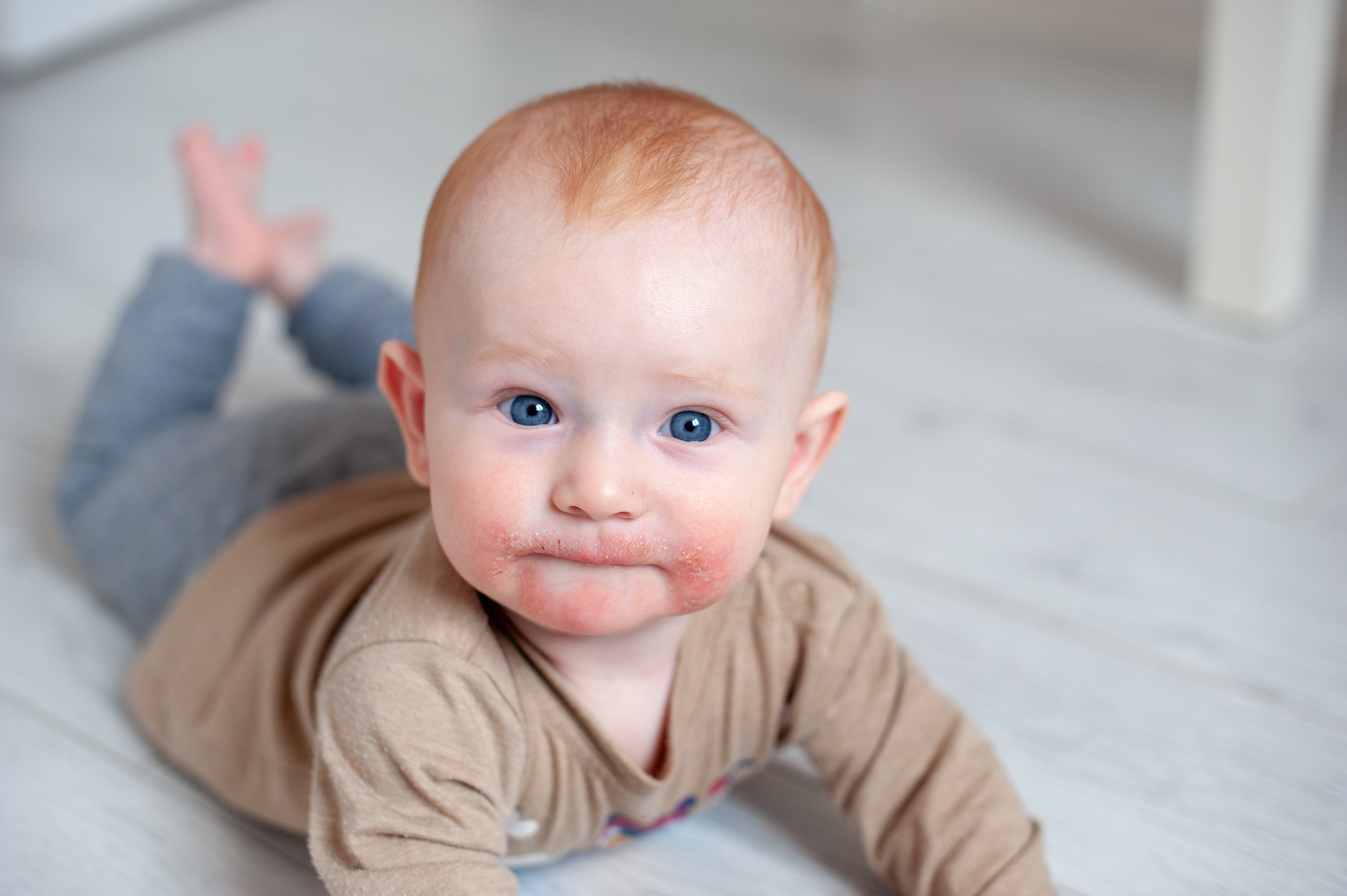 Foto eines Babys, das auf dem Bauch liegt und Neurodermitis Symptome wie Ekzeme und Hautrötungen am Mund zeigt.