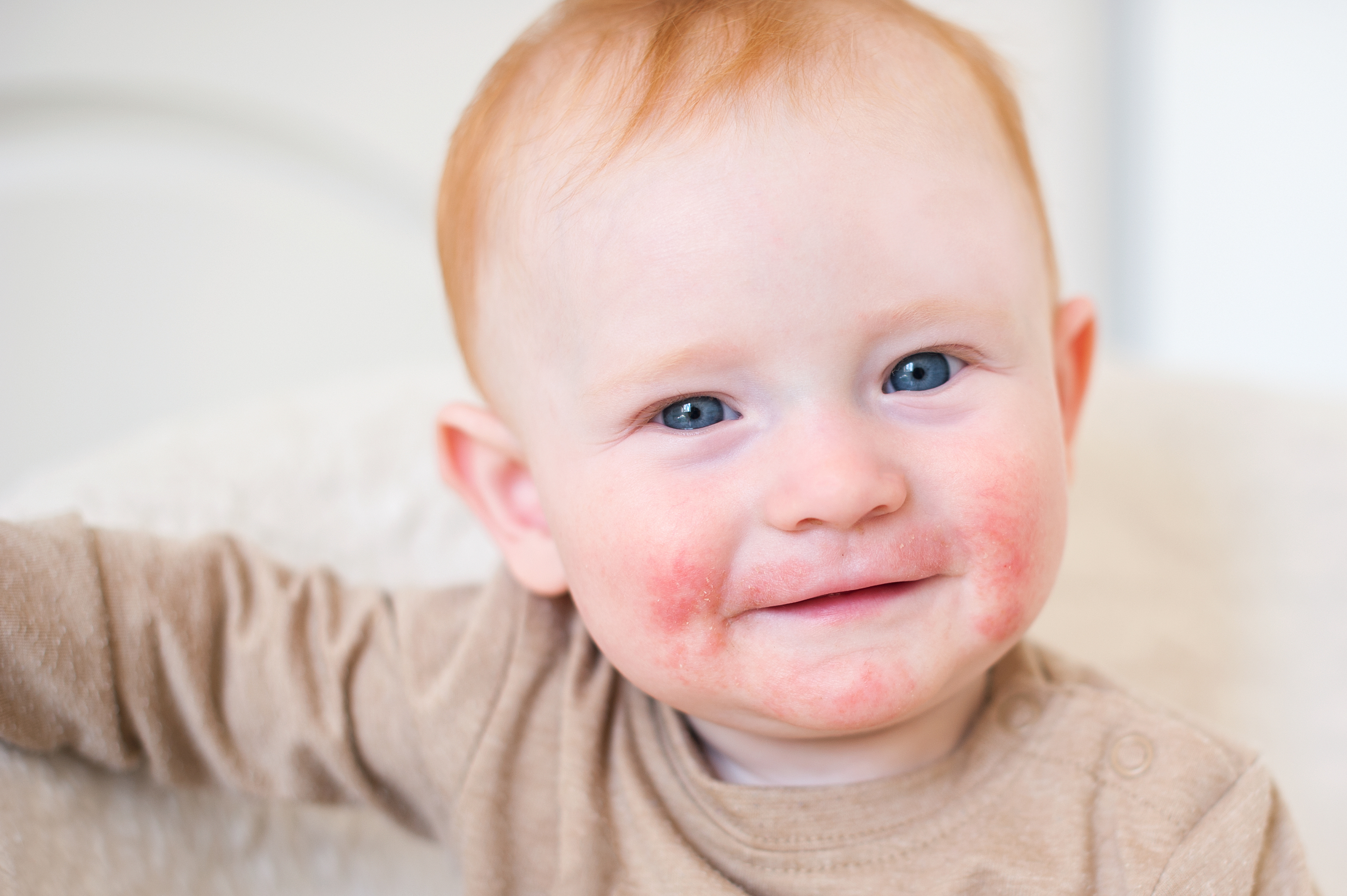 Baby mit Neurodermitis Symptomen am Mund